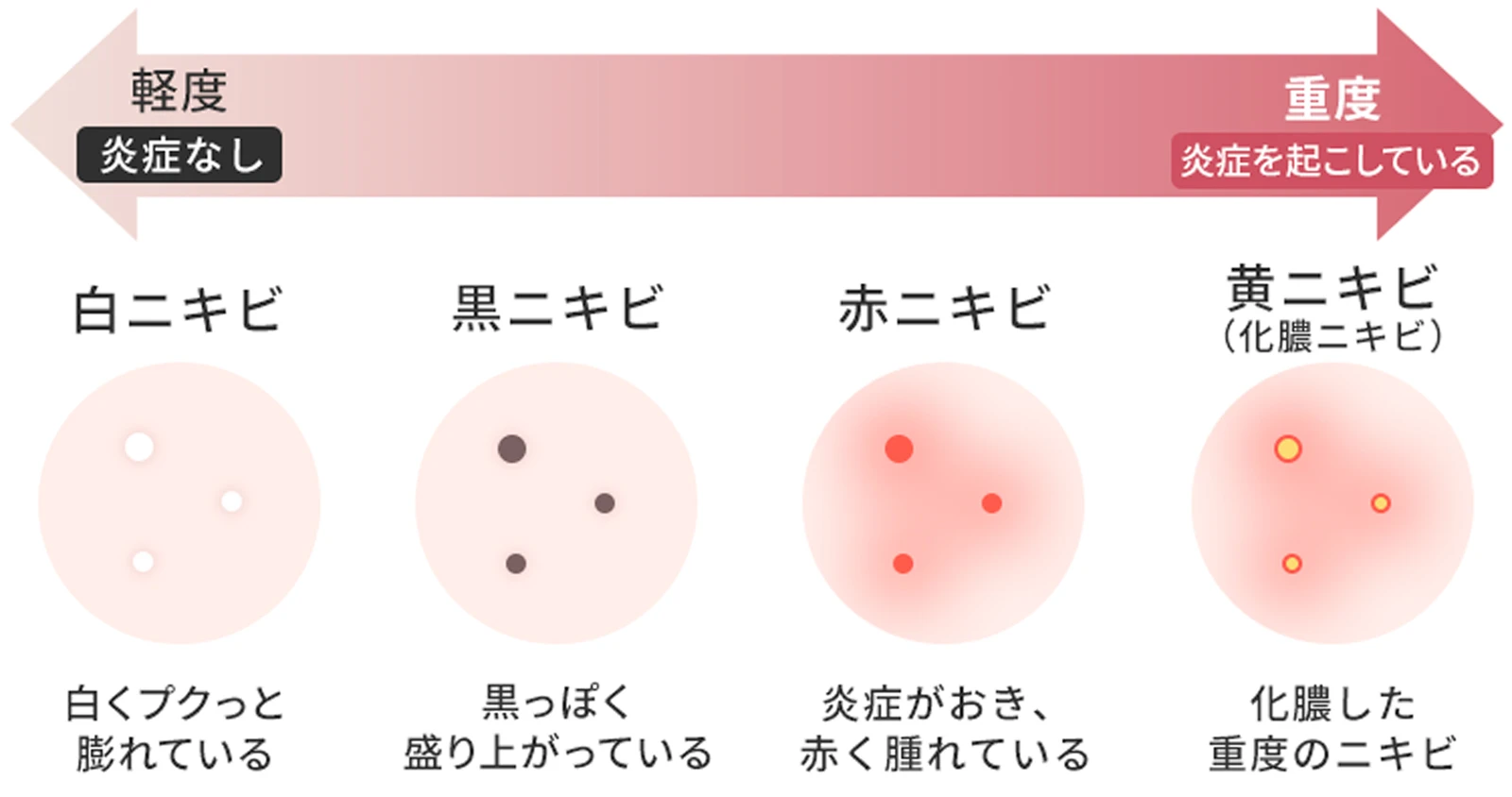 ニキビの進行と4つのタイプ