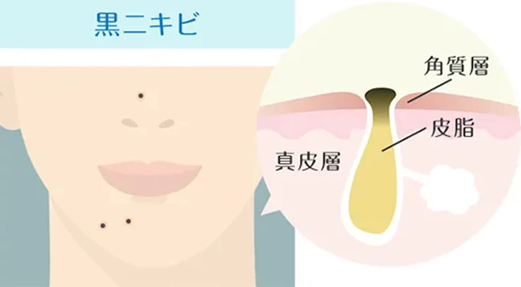 黒ニキビの詳細図