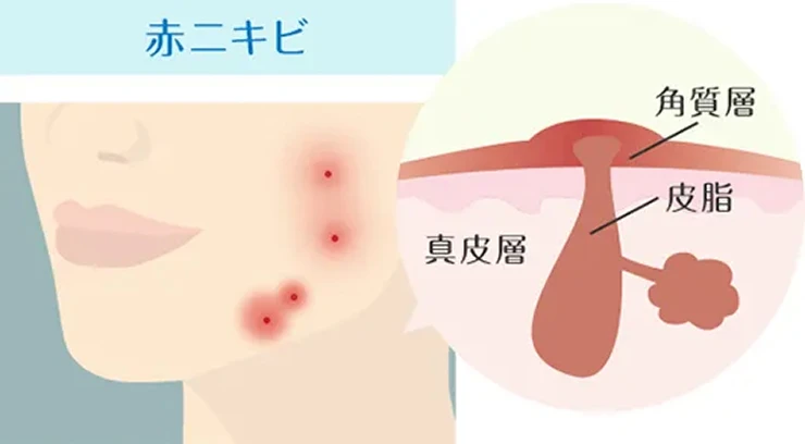 赤ニキビの詳細図