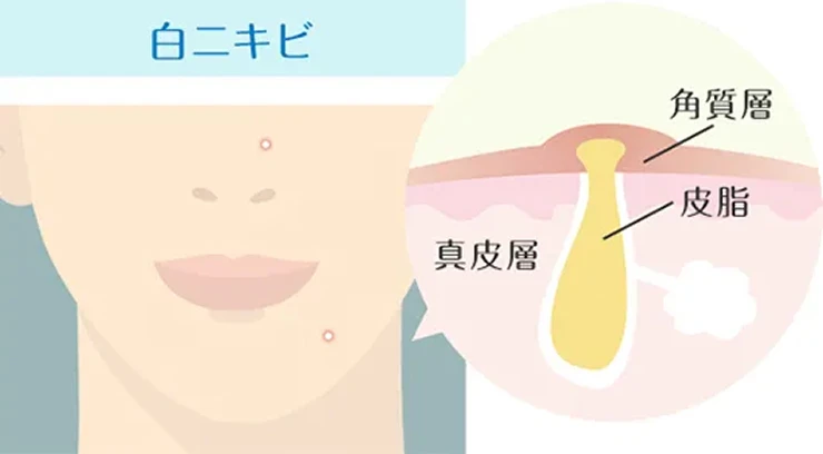 白ニキビの詳細図