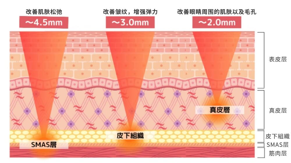 针对皱纹和松弛下垂 从皮肤内部再生紧致