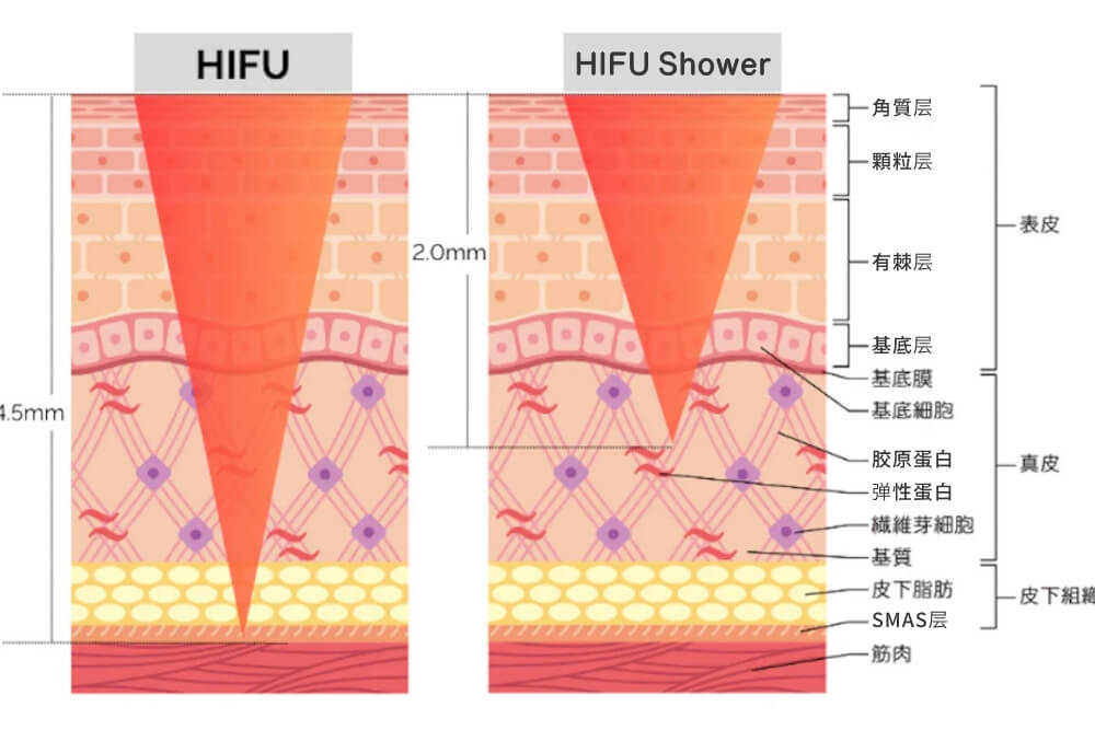 Ultra V Lift 无针埋线