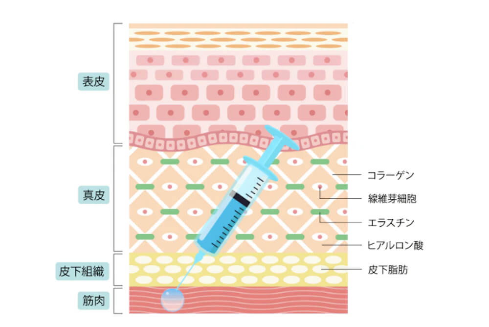 保妥适除皱针