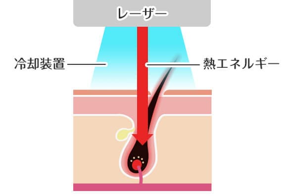 レーザーの熱と痛み