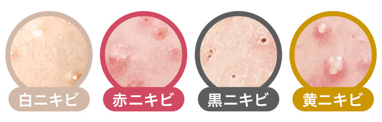あなたのニキビはどれ？