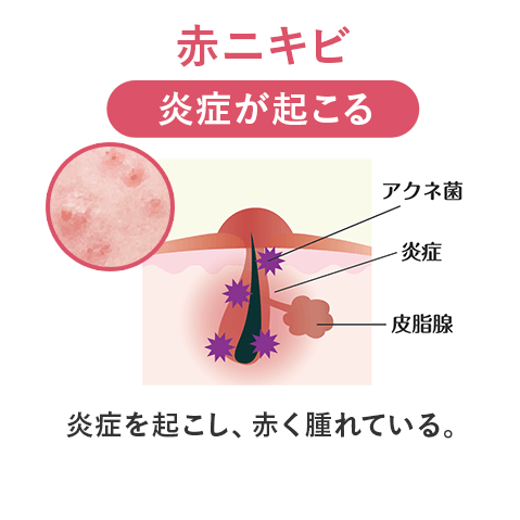 赤ニキビ 毛穴の状態