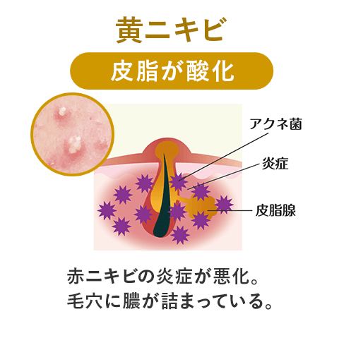 黄ニキビ 毛穴の状態