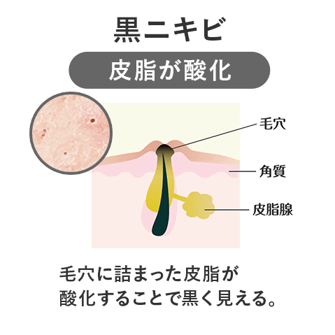 黒ニキビ 毛穴の状態