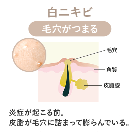 白ニキビ 毛穴の状態