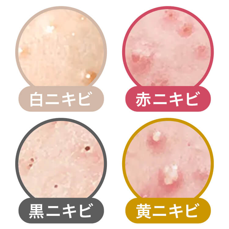 あなたのニキビはどれ？