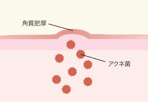 ニキビができてしまう仕組み