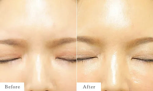 眉間のbefore after