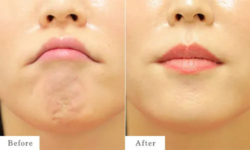 アゴのbefore after