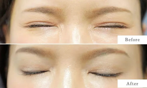 目尻のbefore after
