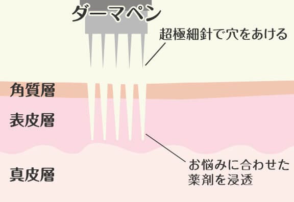 お肌に微細な穴をあける
