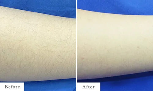 腕脱毛のbefore after
