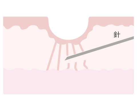 ②ニキビ跡の下の固い線維を針で切ります
