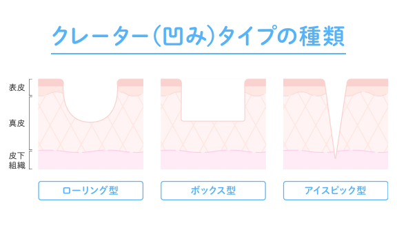 クレーターの種類