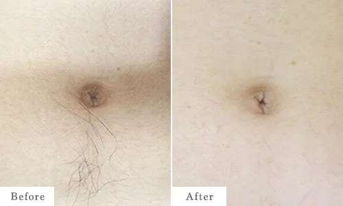 腹部脱毛（へそ周り）のbefore after