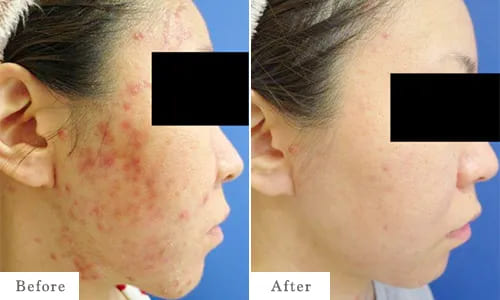 顔のニキビ治療のbefore after