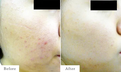 ケミカルピーリングのbefore after