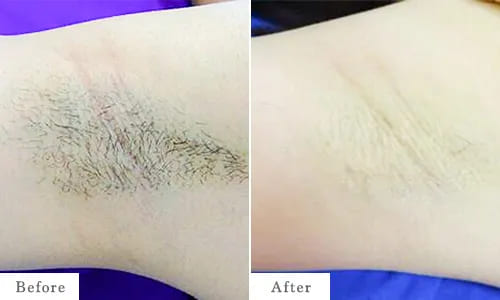 両ワキ脱毛のbefore after