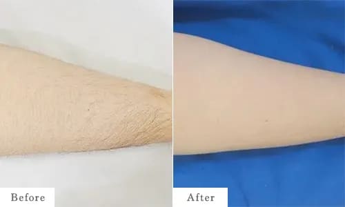 ひざ下（裏側）の脱毛のbefore after