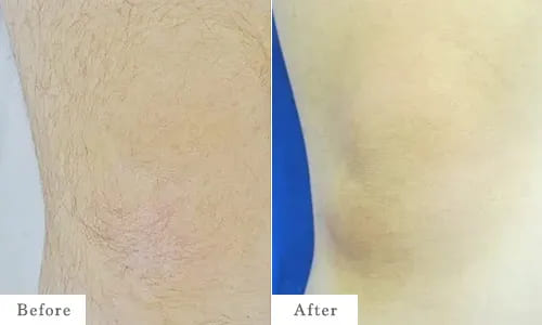 ひざの脱毛のbefore after