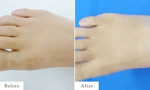 足指甲の脱毛のbefore after