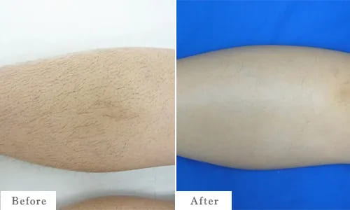 ひざ下脱毛のbefore after