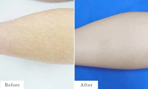 ひざ下脱毛のbefore after