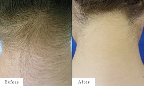 うなじ脱毛のbefore after