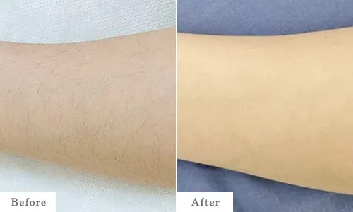 ひじ下脱毛のbefore after