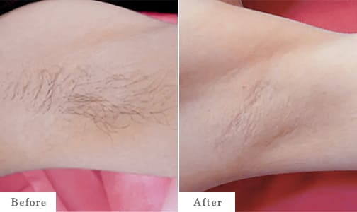 ワキ脱毛のbefore after