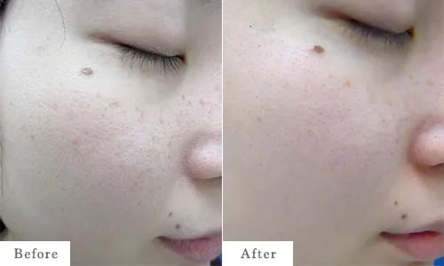 毛穴治療のbefore after