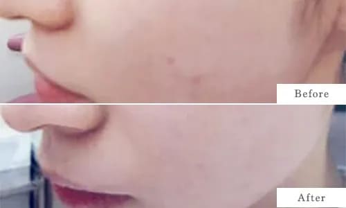 ACRS(再生治療)のbefore after