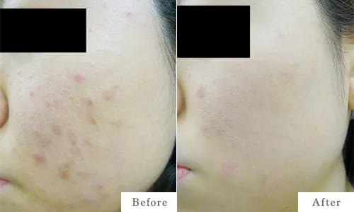 ケミカルピーリングのbefore after