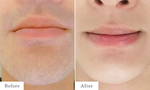 ヒゲの医療レーザー脱毛のbefore after