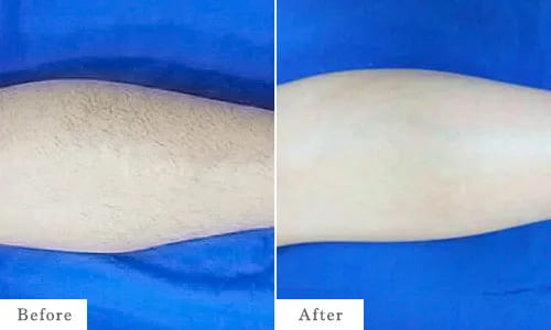 ひざ下脱毛のbefore after