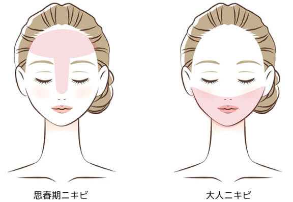 思春期ニキビと大人ニキビ