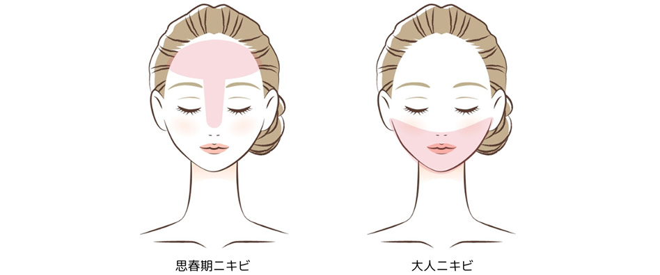 思春期ニキビと大人ニキビ