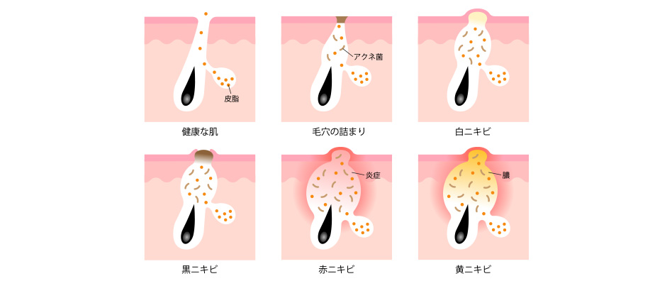 思春期ニニキビの進行過程キビと大人ニキビ