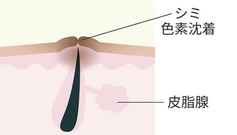 色素沈着タイプのニキビ跡