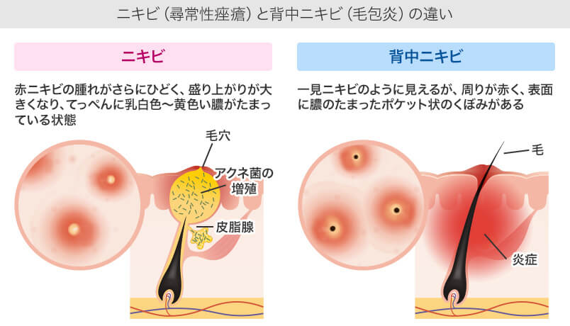 マラセチアによる背中ニキビ