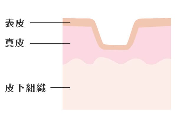 クレーター毛穴