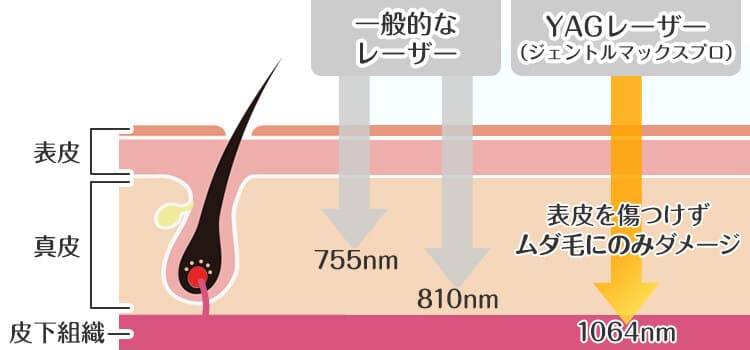 安全性の高い脱毛機器を使用