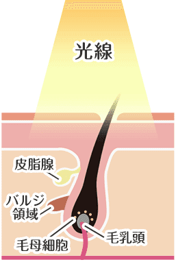 医療脱毛の仕組み