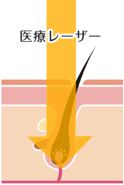 医療脱毛の仕組み