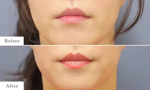 ボトックス注射のbefore after