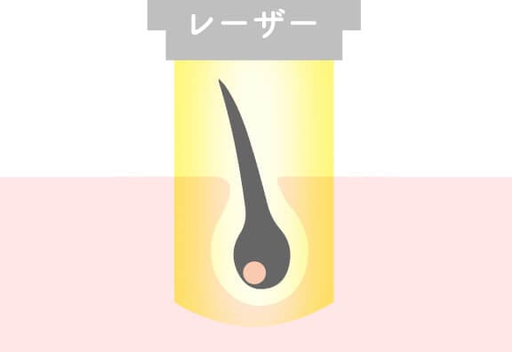レーザー脱毛